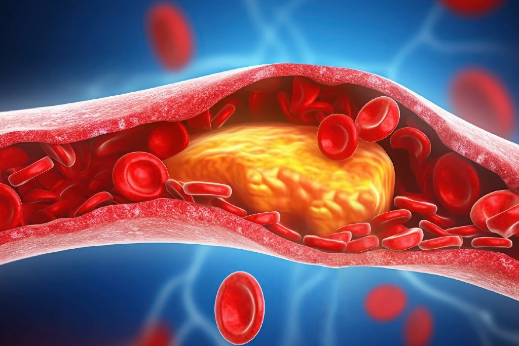 High Cholesterol